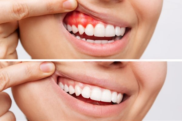receding gums stages